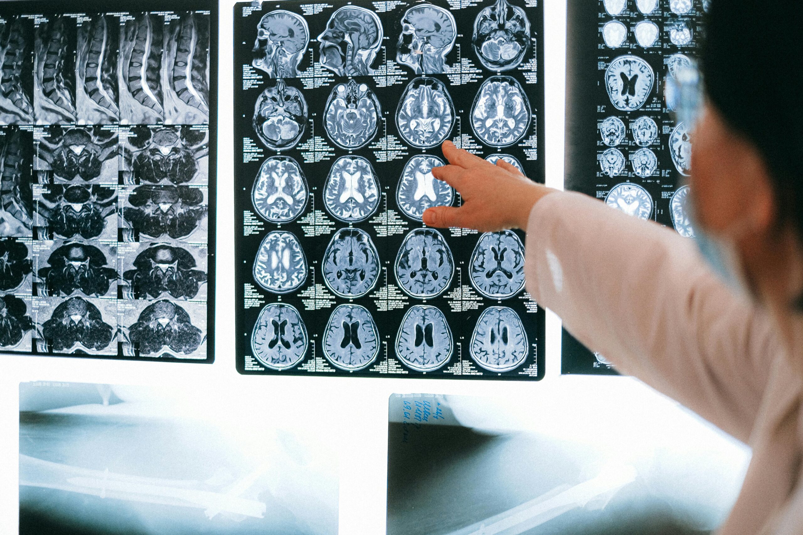 Tips om te leren hoe je met epilepsie omgaat
