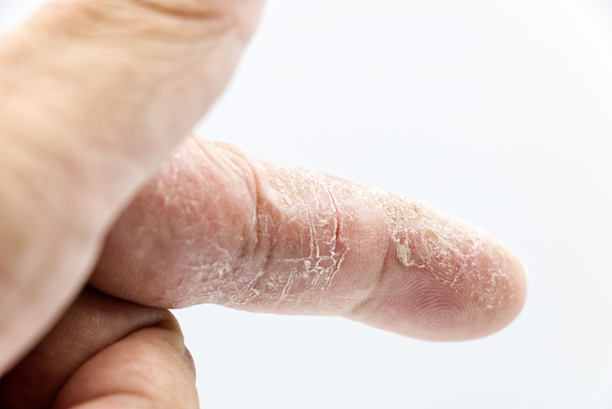 Tips om met psoriasis om te gaan
